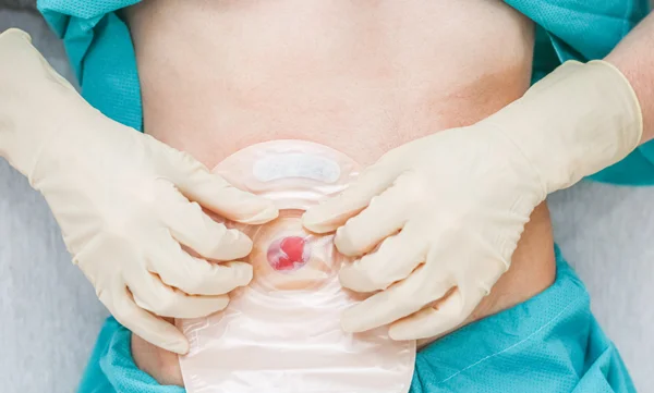 Laparoscopic Myomectomy or Fibroid Surgery with InBag Morcellation