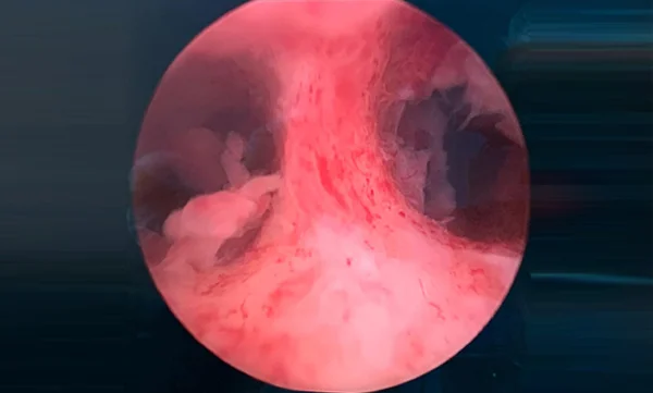 Hysteroscopic Septal Resection or Synechiolysis