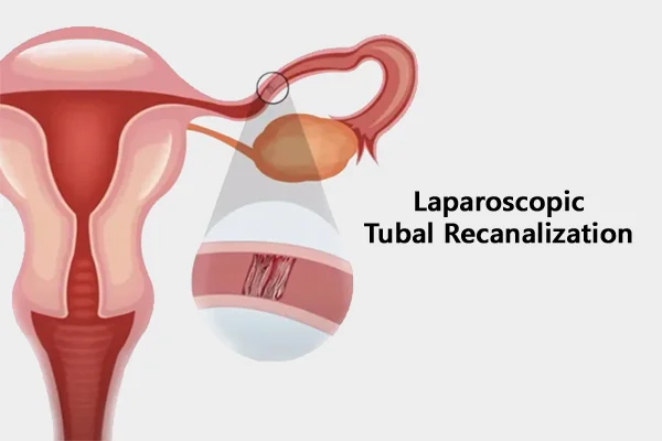 Laparoscopic Tubal Recanalisation or Opening of Blocked Fallopian Tubes