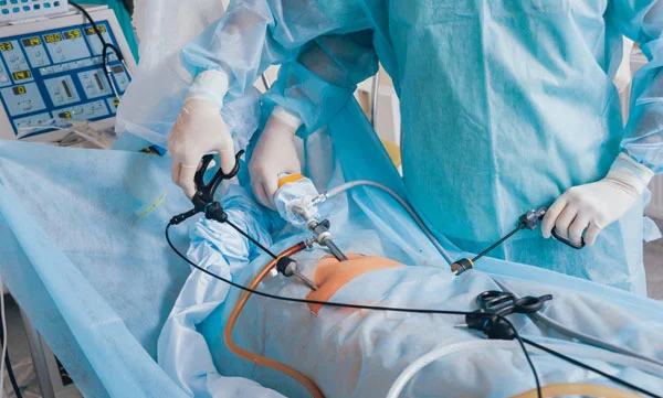 Laparoscopic Ovarian Cyst Removal