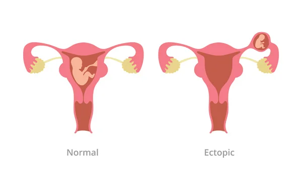 Ectopic Pregnancy Treatment by Medical and Laparoscopic